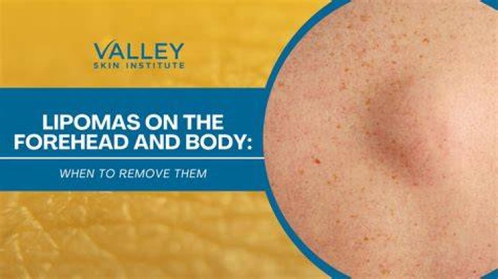 How do lipoma develop?