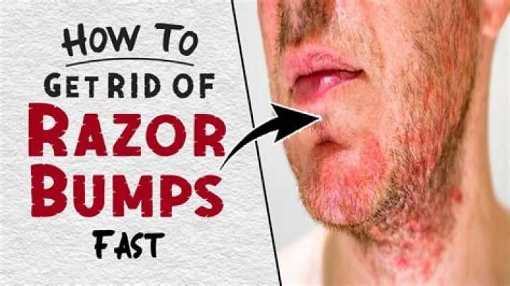 How do you avoid razor bumps?
