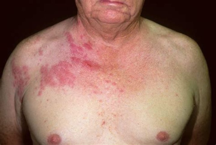 How do you describe shingles rash?