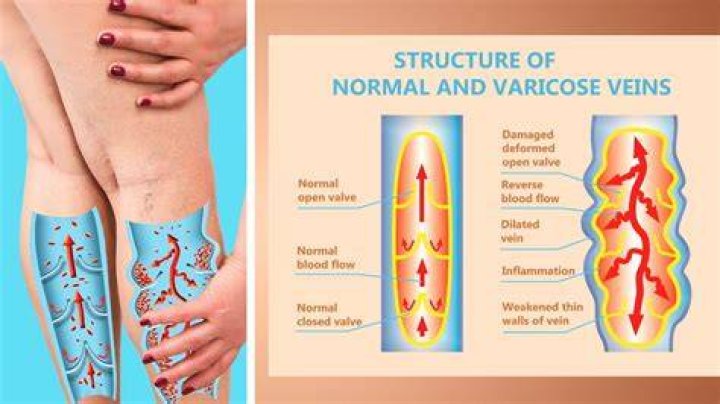How do you describe varicose veins?