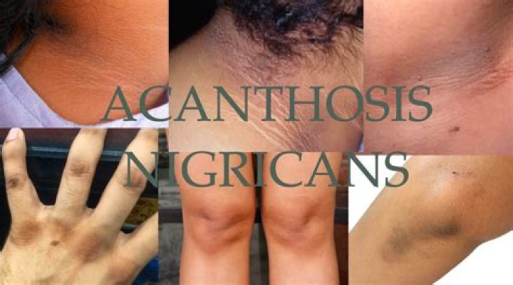 How do you fix acanthosis nigricans?