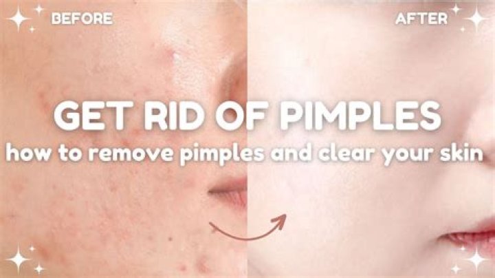 How do you get rid of a pimple with no head?
