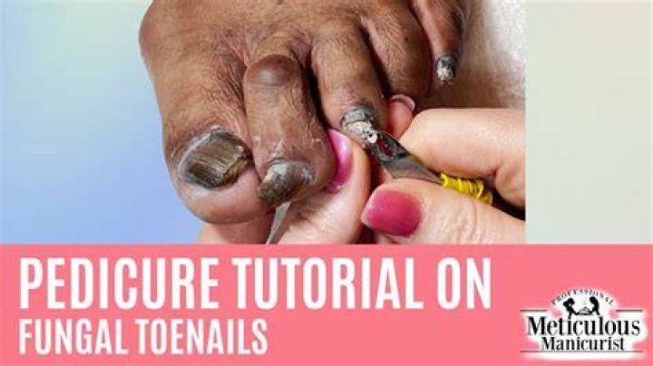 How do you get rid of black toenails?