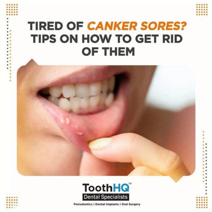 How do you get rid of canker sores on your tongue?