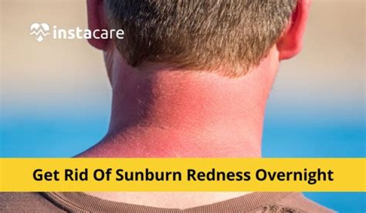 How do you get rid of sun burn marks?