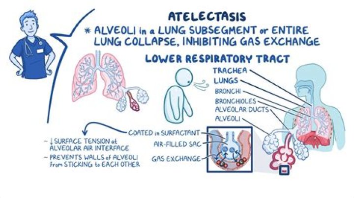 How do you prevent atelectasis after surgery?