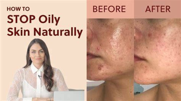 How do you stop oily skin?