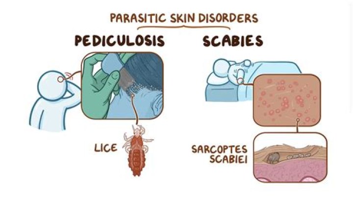 How do you tell if you have body lice or scabies?