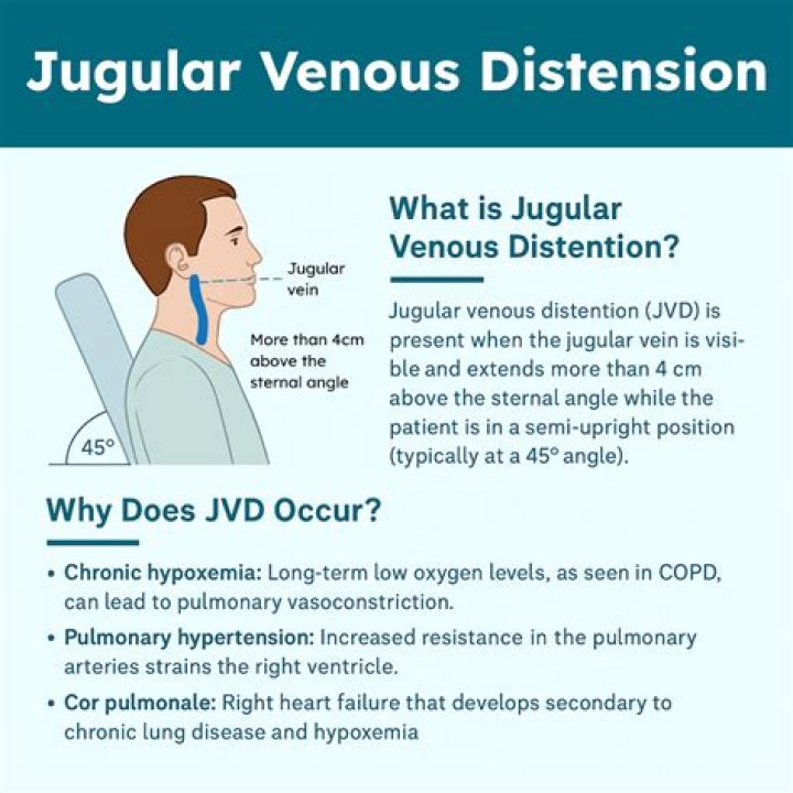 How do you test for JVD?