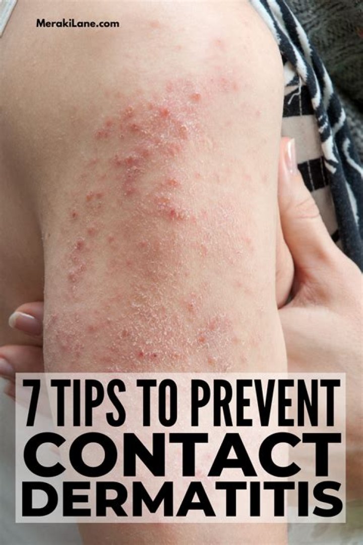 How do you treat contact dermatitis naturally?