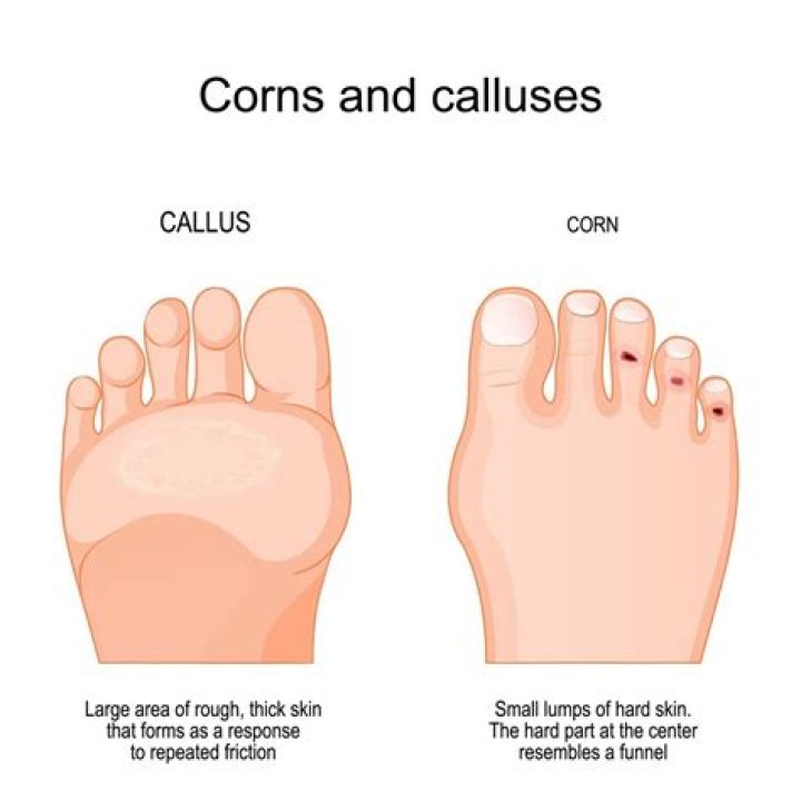 How do you treat corns on your toes?