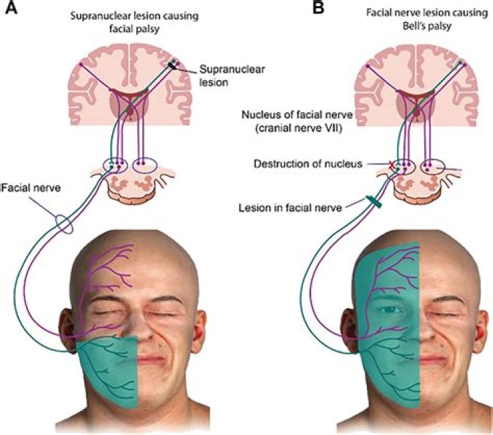 How do you treat facial paralysis?