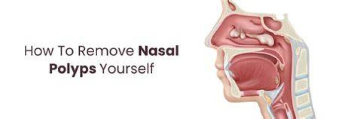How do you treat nasal polyps at home?