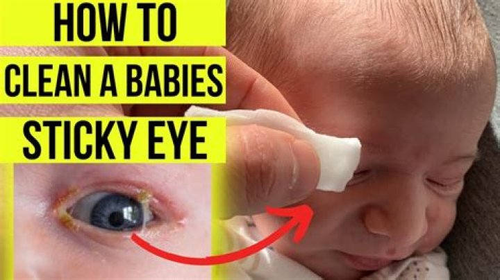 How do you treat sticky eyes in babies?