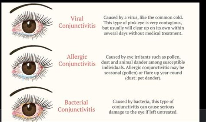 How do you treat viral conjunctivitis?