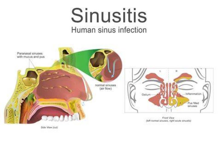 How does a sinus infection start?