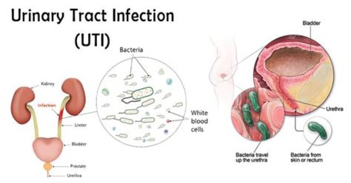 How does a urinary tract infection affect the excretory system?