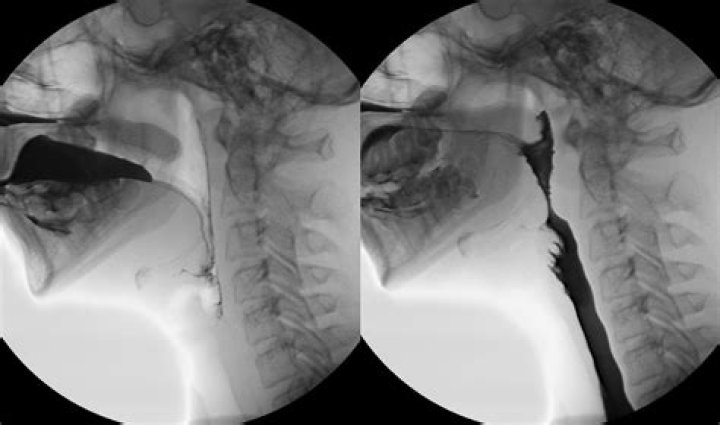 How is a barium swallow test done?