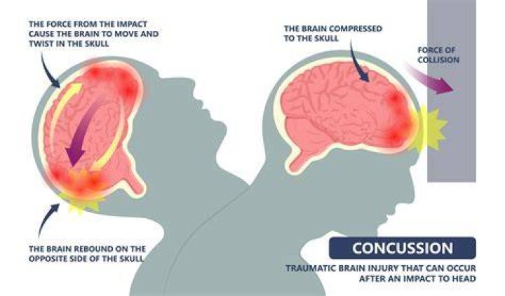 How is a concussion?