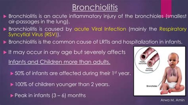 How is bronchiolitis diagnosed? | ContextResponse.com