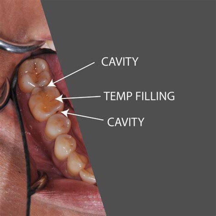 How long can dental filling last?