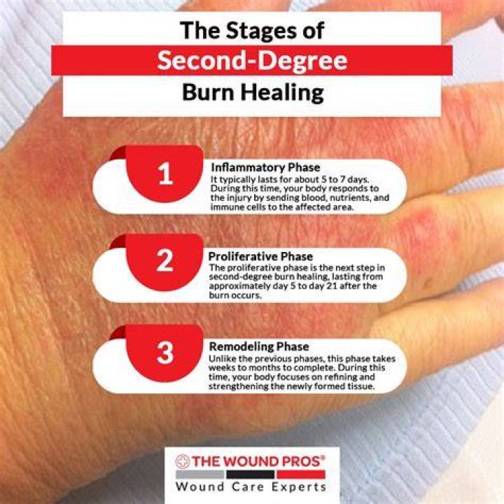 How long do cigarette burns last?