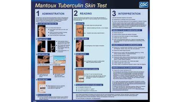 How long do TB test results take?