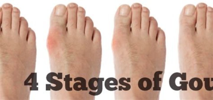 How long does gout last in foot?