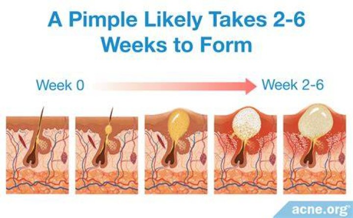 How long does it take for red pimples to go away?