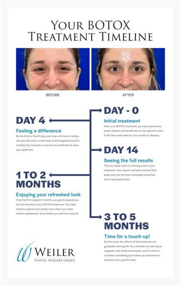 How long does it take for the swelling to go down after Botox?