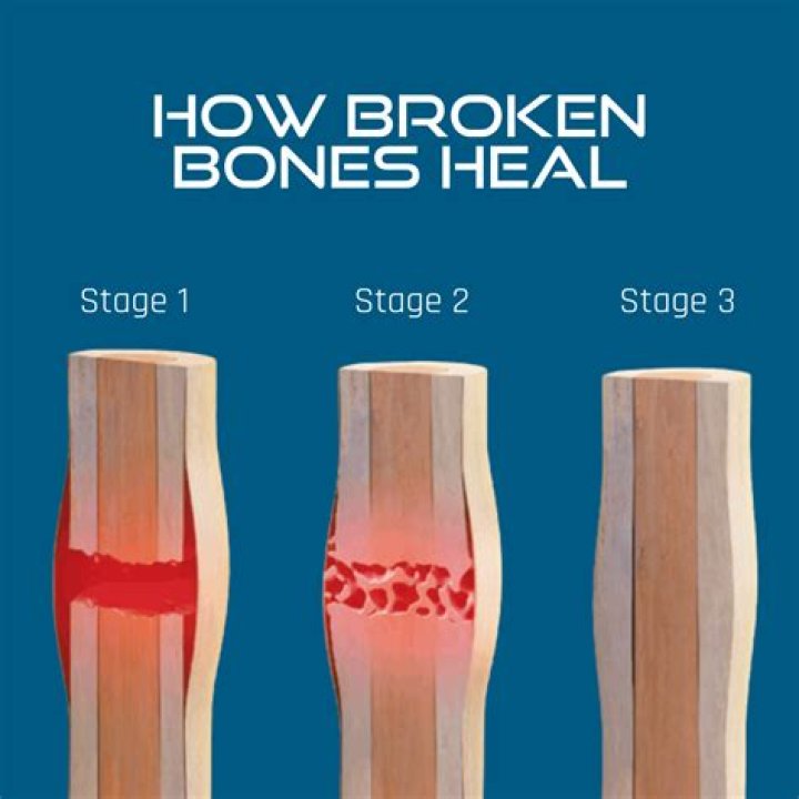 How long does it take to heal a broken humerus?