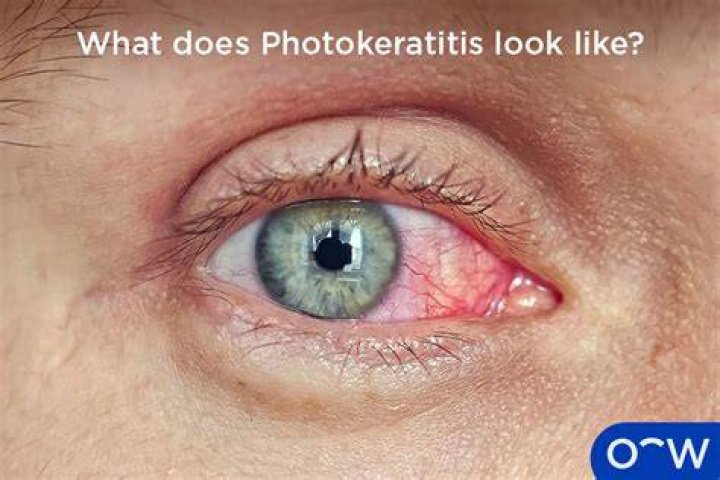 How long does Photokeratitis last?
