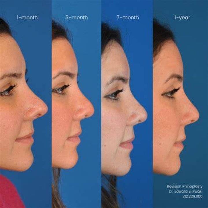 How long does the pain last after a nose job?