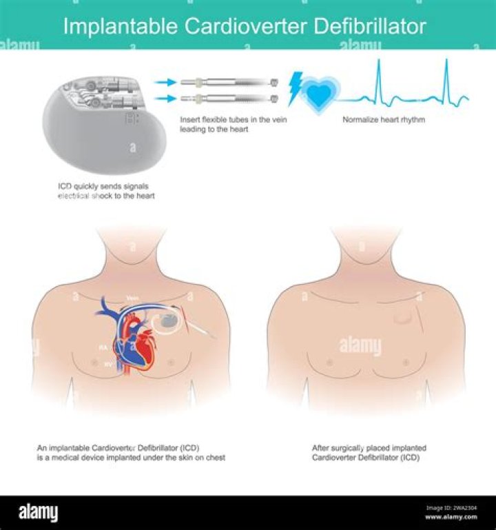 How many volts is a heart defibrillator?