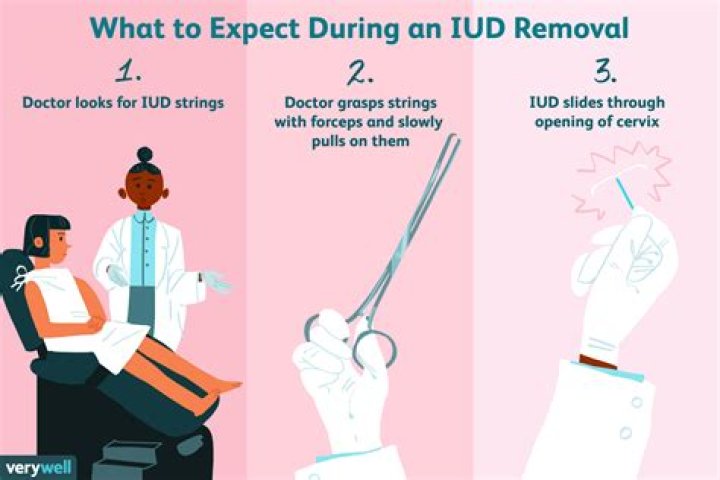 How much is IUD removal?