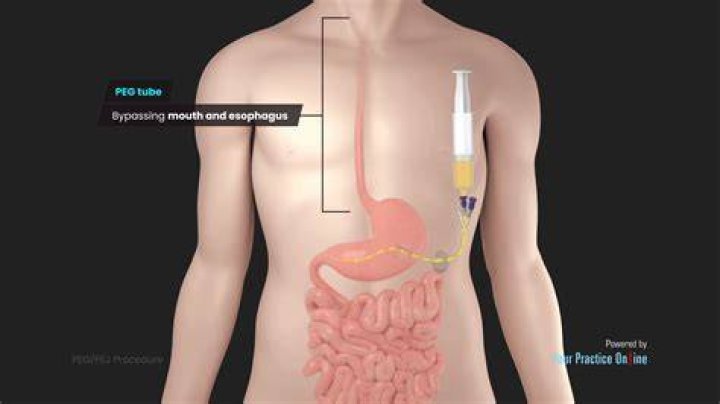 How much residual is normal for PEG tube?