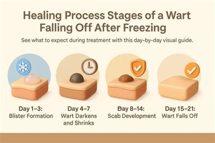 How often should I freeze a wart?