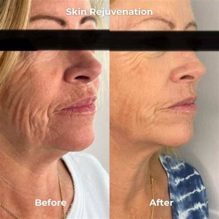 How often should you microneedle your face?