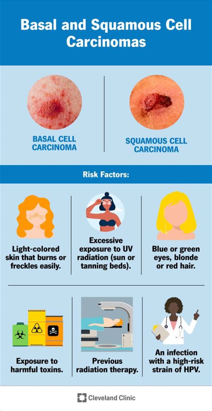 How serious is invasive squamous cell carcinoma?