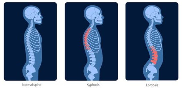 How would you Recognise lordosis?