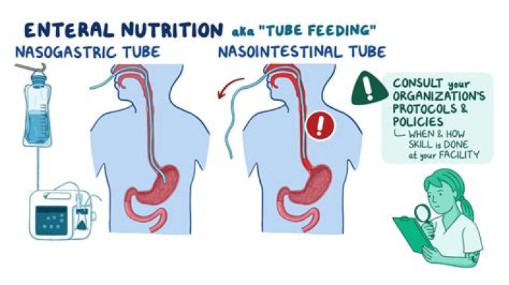 Is AG tube permanent? | ContextResponse.com