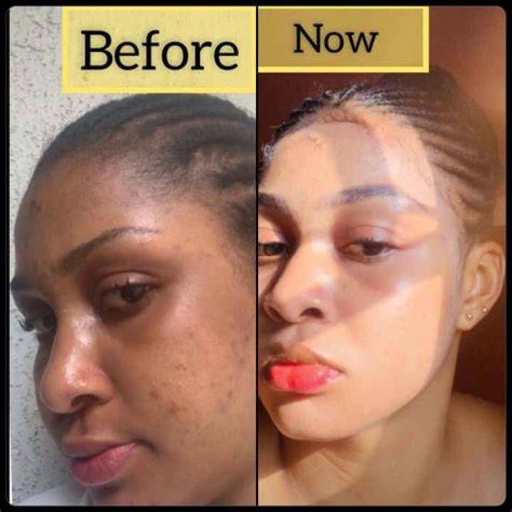 Is bleaching good for skin?
