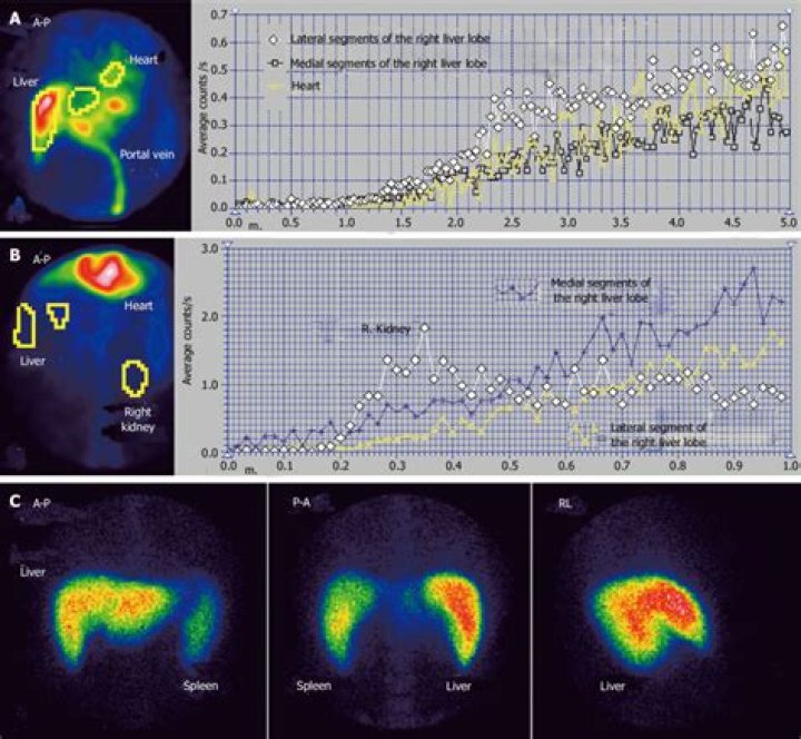 Is Budd Chiari genetic? | ContextResponse.com
