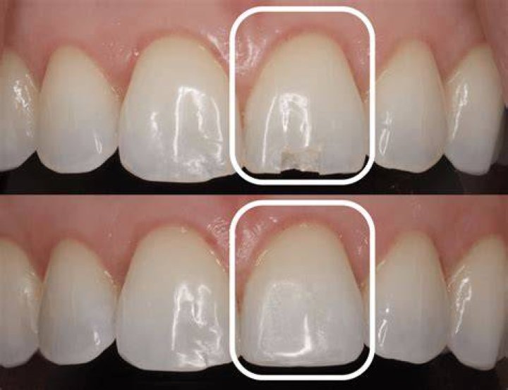 Is chipped enamel dangerous? | ContextResponse.com