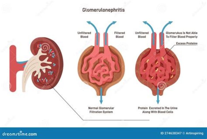 Is IgA nephropathy a glomerulonephritis?