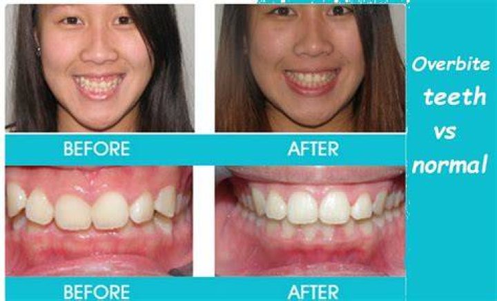 Is it normal to have 32 teeth?