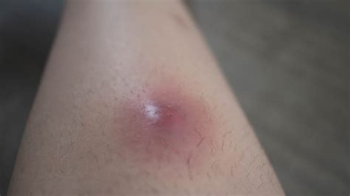 Is it OK to put ice on an abscess?