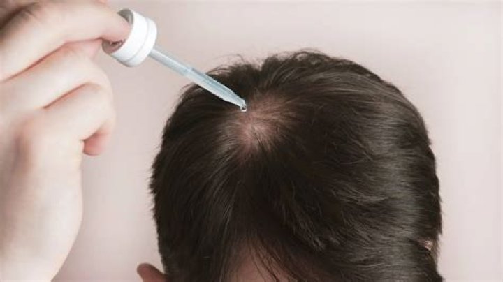 Is Minoxidil a DHT blocker?