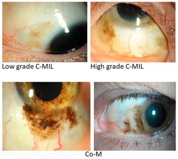 Is ocular Melanosis cancerous? | ContextResponse.com