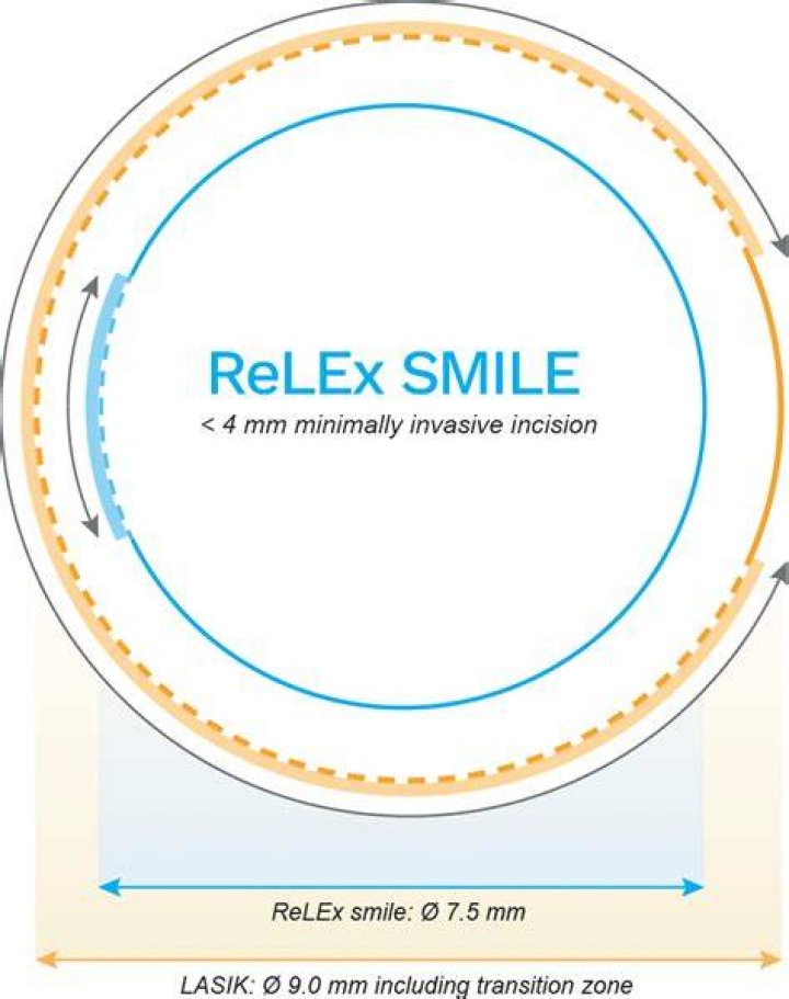 Is ReLEx Smile Safe?